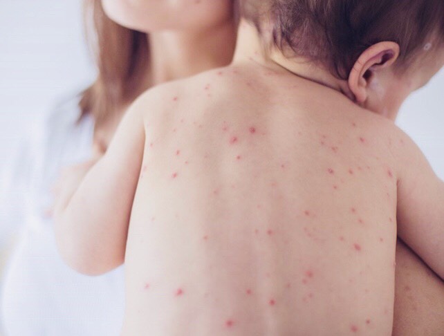 BÀI TUYÊN TRUYỀN PHÒNG CHỐNG BỆNH THỦY ĐẬU